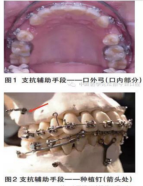 什么是生理性支抗控制——许天民教授