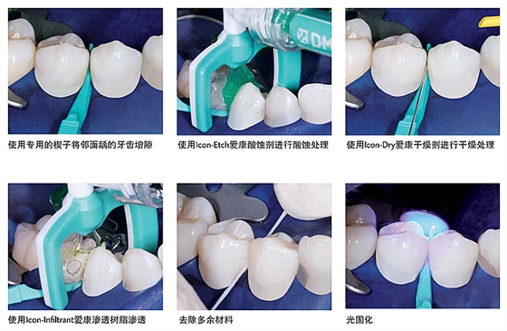 lcon爱康渗透树脂——邻面龋系列应用