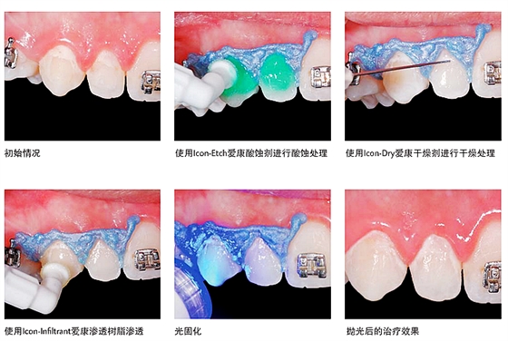 lcon爱康渗透树脂——唇颊面龋系列应用