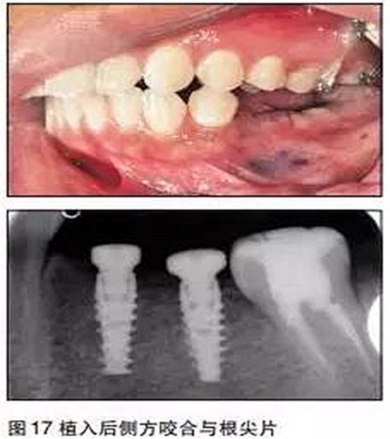 利用支抗钉压低对颌过长牙后种植修复
