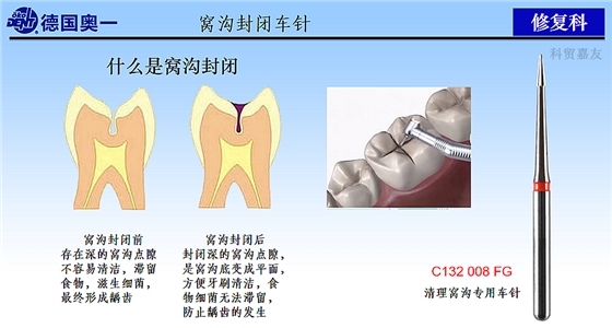 什么是窝沟封闭