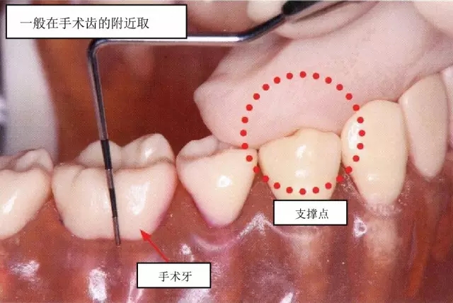 关注牙周 【牙周治疗笔记】学习牙周基础治疗之探针后牙部位的牙周袋