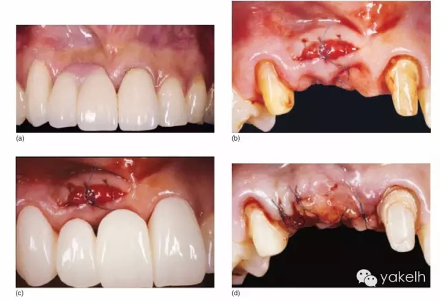 牙周美学治疗目前结缔组织移植的方法