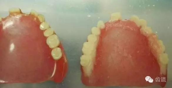 用复制义齿作个别托盘,修整边缘,然后做闭口印模