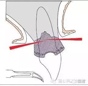 改良widman 翻瓣术――(牙合)面观a:内斜切口;b:翻瓣;c:瓣复位及