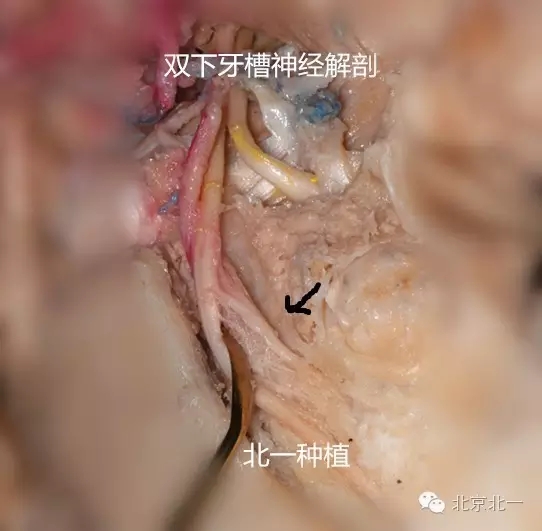 贡献及其珍贵的上颌窦解剖照片